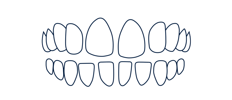 dientes separados