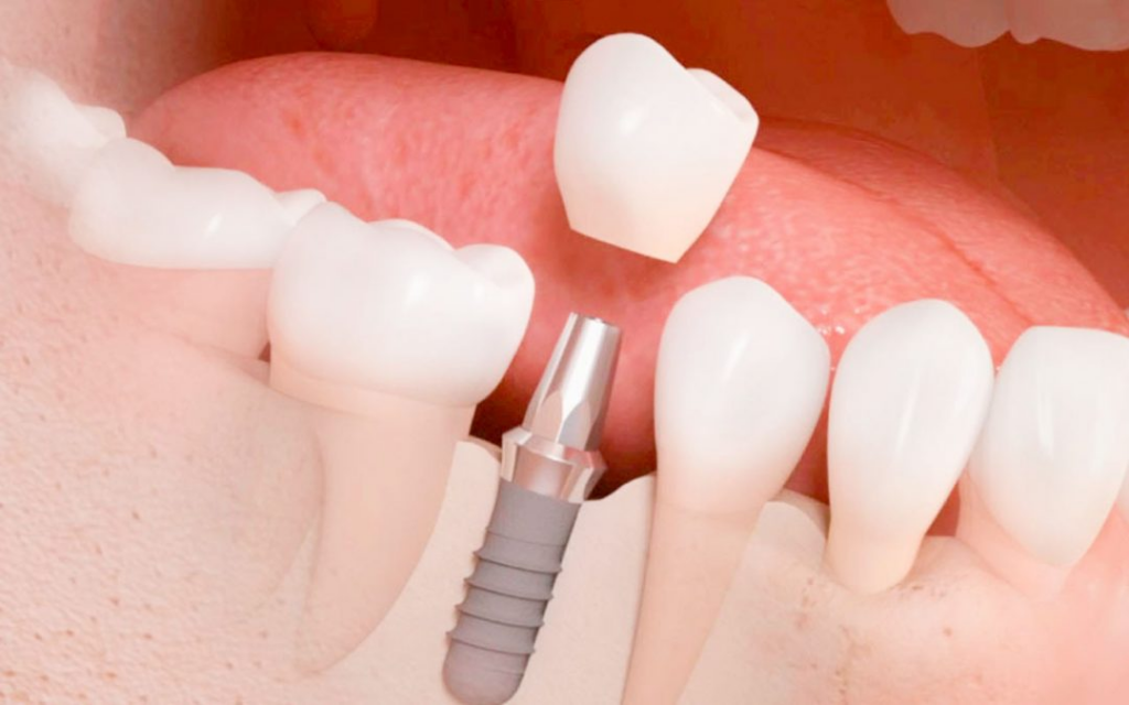 Tipos de implantes dentales: todo lo que necesitas saber